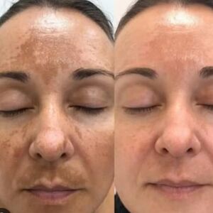 Dark spot and acne treatment  oil